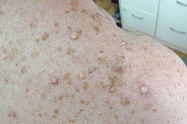 RAF inhibitors - Cutaneous neoplams verruca keratoses 1 Photo- exposed and non photo-exposed