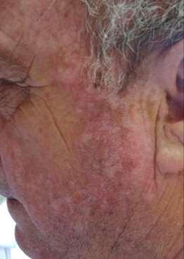 RAF inhibitors Non scarring alopecia Facial erythema Eruptive milia Epidermal cysts Radiation recall dermatitis Lobular panniculitis 1,2