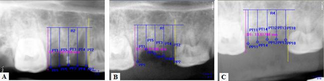 Figure 4. Measurements of bone height using the image analysis software (Image Pro Plus 5.