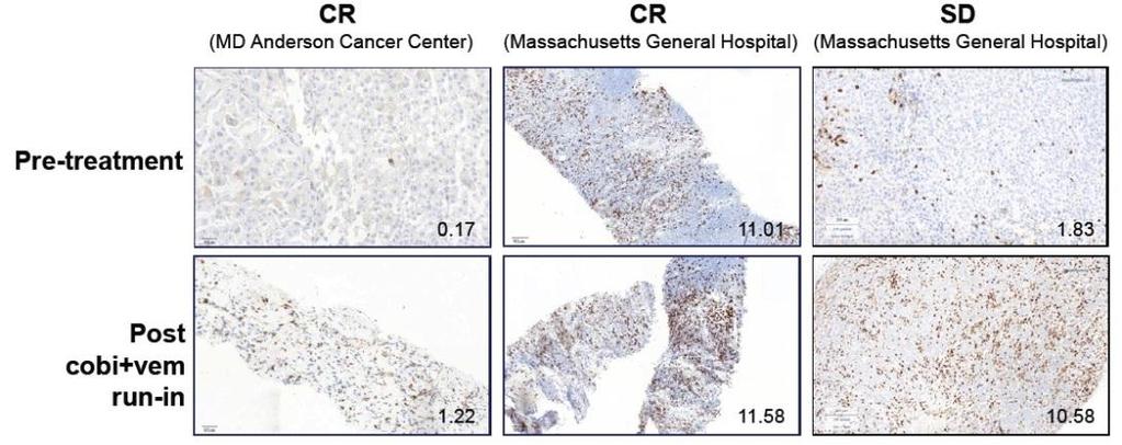 Change in sum of longest diameters from baseline (%) Triple therapy shows promising anti-tumour activity in BRAF V600 mutant melanoma Phase Ib Atezolizumab + cobimetinib + vemurafenib Tumour CD8 + T