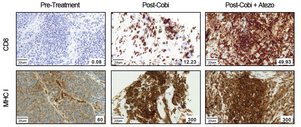 MEK and PD-L1 inhibition increase CD8+ T-cell infiltration and MHC I expression Phase I Cobi + Atezolizumab in metastatic melanoma Treatment with cobimetinib increased intra-tumoural CD8+ T-cell