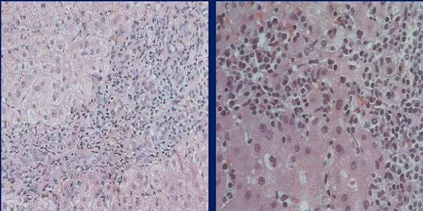 AIH Histology Histologic hallmarks of autoimmune hepatitis: 1) Interface hepatitis (A) occurs when the lymphocytes in the portal triad invade the