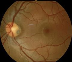 Optic Nerve Anomalies Raman Bhakhri, OD, FAAO Southern California College of Optometry Marshall B.