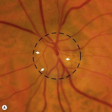 Signs and Symptoms Signs: Small optic disc with large vasculature