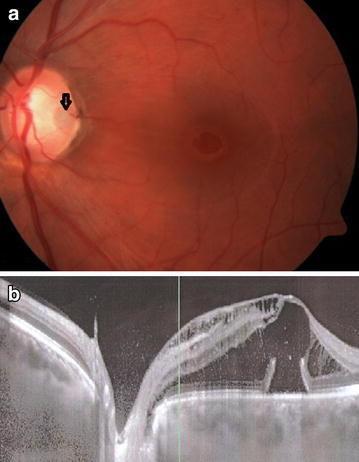 Optic Disc Maculopathy Optic disc pit maculopathy: macular changes that occur which include intraretinal and subretinal fluid accumulation, and RPE changes Maculopathy occurs in 25 75% of patients