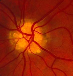 membrane nonarteritic anterior ischemic optic neuropathy retinal vascular occlusions Clinical Pearls How can I confirm the ONH drusen?