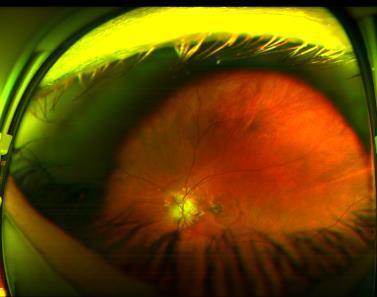 . VFL occurs more frequently in eyes with ONHD