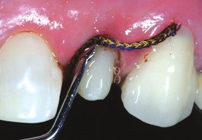 drip, or migrate to other teeth Great for same-day