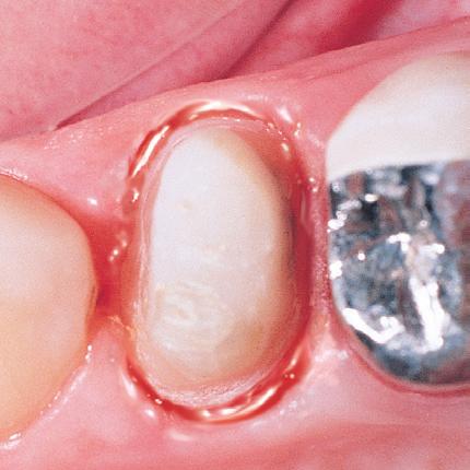 gel in sulcus around tooth preparation.