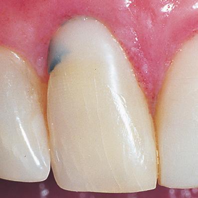 Direct Bonding 1. MICROLEAKAGE Several Class V restorations were performed on these anterior teeth two months prior.