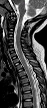 MRI findings 7 patients had MRI signal abnormalities on T2 weighted