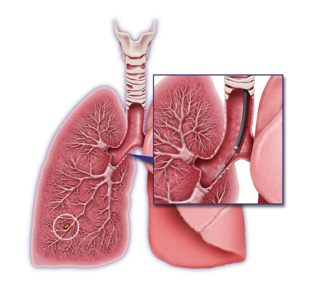 Pipeline Highlight Nasal swab test for early lung cancer detection Exploiting novel, proprietary field of injury science that powers Peripheral lung nodules difficult to biopsy leading to late-stage