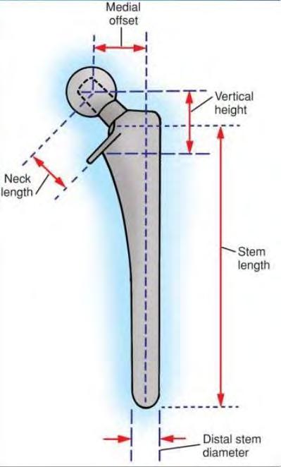 Techniques to increase offset increasing length of femoral neck decreasing neck-shaft angle medializing the