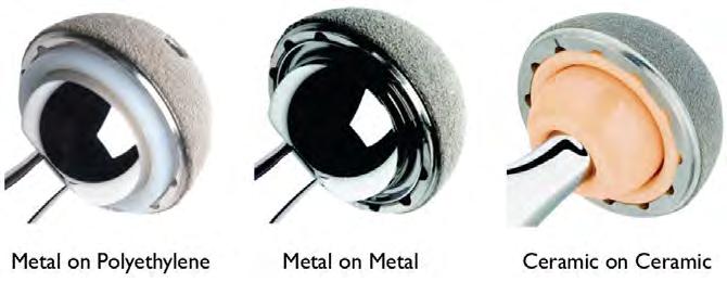 (uncemented) metal bearing