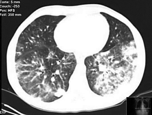 34 Fig. 2. CT showing lung infiltrative processes. References 1 Schwab M, et al: Encyclopedia of Renal Cancer, 2nd ed, 2009, vol 79 85, pp 301 310.