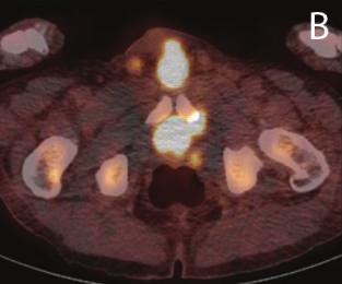 osseous metastatic disease. There was intense uptake in the bladder appearing contiguous with the prostate and penis (Figures 2, 2, and 2(c)).