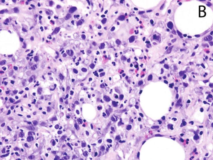 the diagnosis of sarcomatoid renal cell carcinoma.