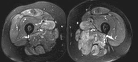 Necrotizing autoimmune myopathy Hx/ 61-year-old woman complained about progressive muscle weakness in arms and