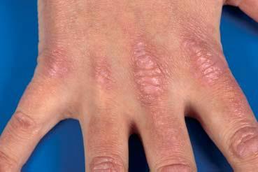 Dermatomyositis Facial rash in the shape of a butterfly on