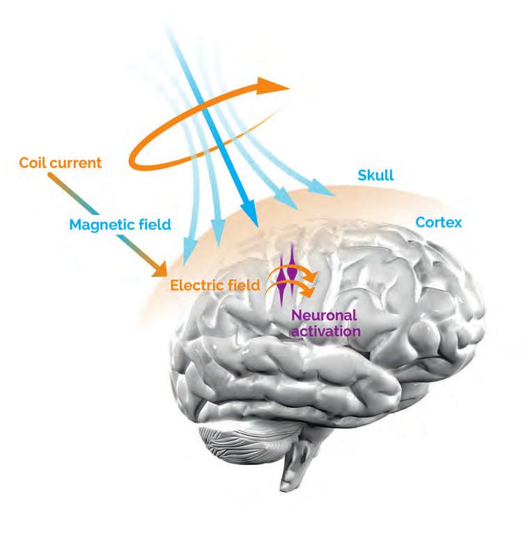 InTroduCTIon InTroduCTIon TMs In general TMS (Transcranial Magnetic Stimulation) is a technique where neuronal activity can be influenced by non-invasively stimulating the cortex through the intact
