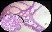 Figure 7: Endometrioid carcinoma; Inset shows villoglandular