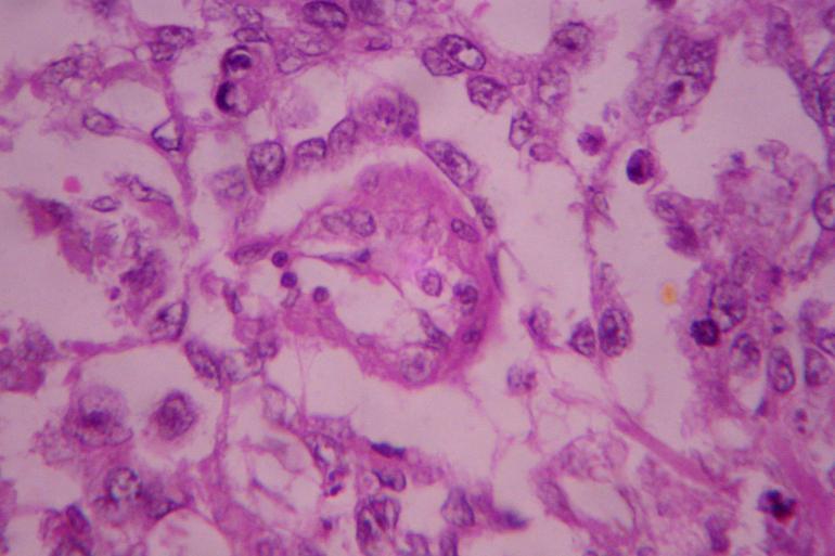 Fig7: Mixed germ cell tumor; Yolk sac component with Schiller-Duval body DISCUSSION: Ovarian germ cell neoplasms are thought to be derived from primitive germ cells of the embryonic gonad.