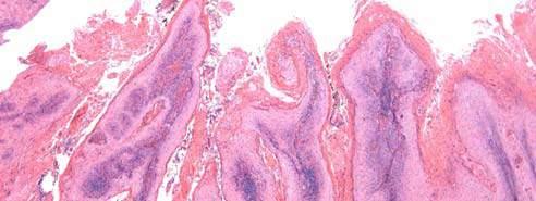 carcinoma Glans Slowly growing Condylomatous/Papillary HPV 16, 18, 35