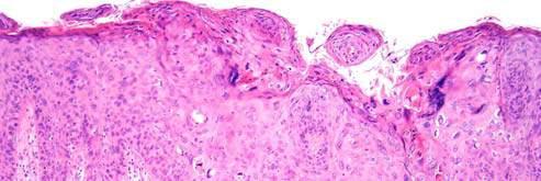 carcinomas and their precursor lesions Distinctive association of p16 over-expression