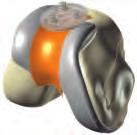 The only true patient-specific bicompartmental knee implant just got better Unparalleled fit, wear optimized design Constant coronal radius on condyle of femoral