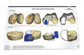 removal guide Patient-specific anterior and