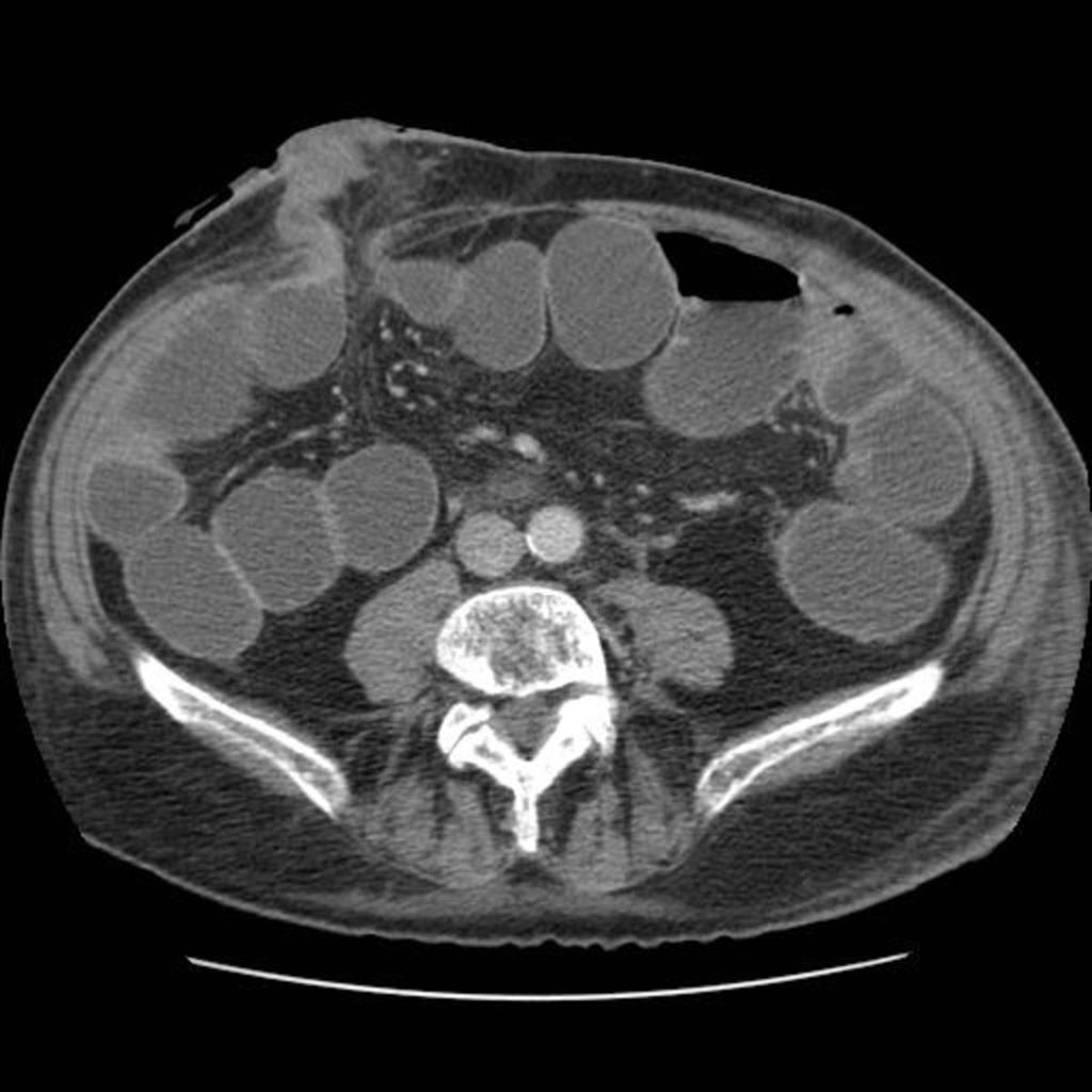 Fig. 0: Axial CT image in a patient with previous colectomy and ileostomy demonstrates
