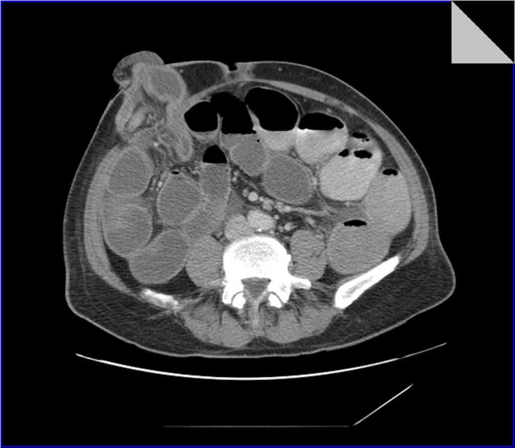 Fig. 0: Axial CT section demonstrates obstructing parastomal hernia in