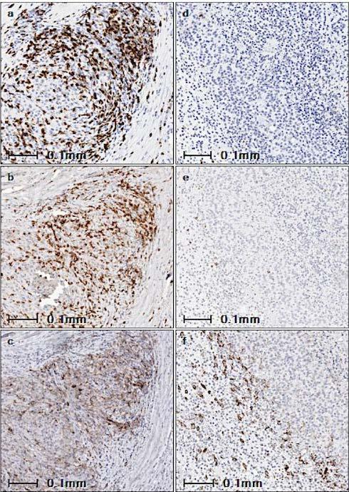 Inhibiting Adaptive Immune Resistance PD-1 Blockade-Induced Responses Response Progression Melanoma cell or tumor macrophage Interferons Hypothesis
