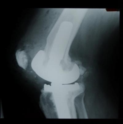 Figure 4 Figure 4 With the advent of modern condylar components, resurfacing of the patella became a standard part of total knee arthroplasty.