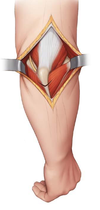 Ulnar nerve Triceps Olecranon Chevron Anconeus Common extensor tendon Ulna 3 Reduce fracture and provide
