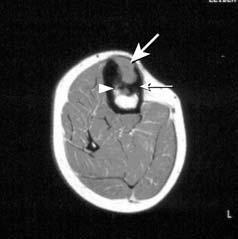Figure 2b Preoperative axial T1-weighted MR scan showing intermediate signal intensity from the centre of the tumour (large arrow), low signal intensity from the sclerotic ridge (small arrow) and