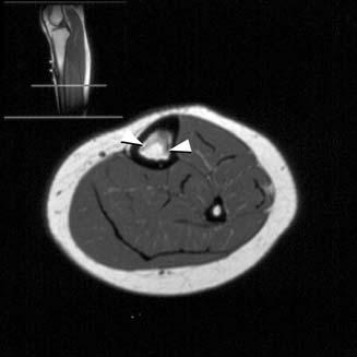 Figure 3a Preoperative axial T1-weighted MR image of the tibia showing the tumour arising from the anterior cortex (arrow) with intermediate signal intensity in the centre and low signal intensity