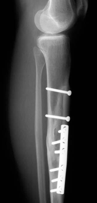 Figure 3c Postoperative radiograph showing reconstruction with a fitted inlay allograft and fixation by a lag screw.
