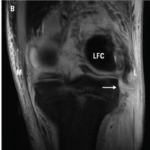 remaining amount 69% of varus load at 25deg Posterior structures on slack in flexionpreferred test Secondary: limit ER of a flexed knee Injury Mechanism: Least commonly injured knee ligament