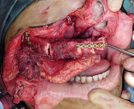 Johan Fagan Anterolateral free thigh flap: This provides good bulk and palatal skin cover, but precludes wearing a denture.