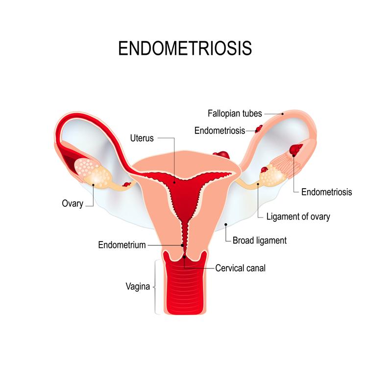 Endometriosis occurs when endometrial cells, which normally line the inner wall of the uterus, develop in abnormal locations in the pelvic cavity, such as on the ovaries, on the fallopian tubes, in