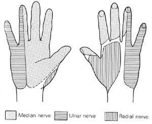 Carpal Tunnel Syndrome Most common peripheral nerve entrapment neuropathy Compression of the median nerve at the level of