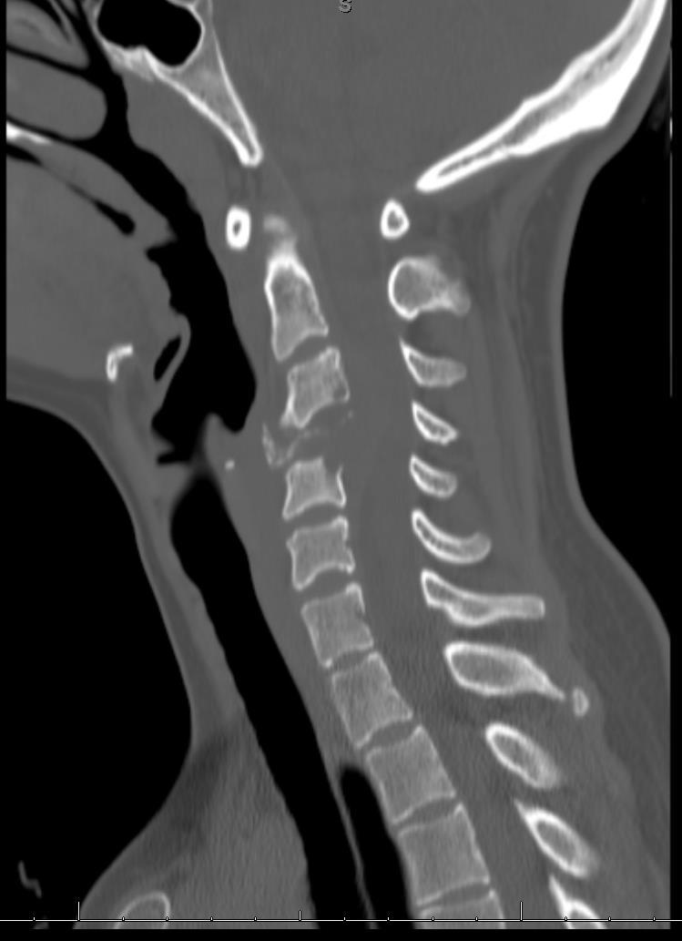 Spine Neurosurgery Case