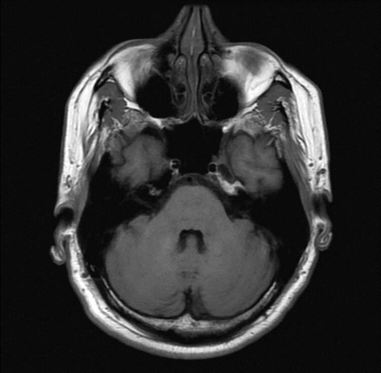 AXIAL SCANS 3 1. Pons 2. Fourth Ventricle 3. Ethmoid Sinus 4.