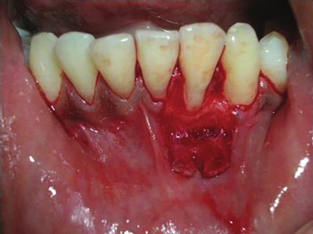 Case Reports in Dentistry Figure 5: Partial thickness flap reflection in relation to tooth number 32.