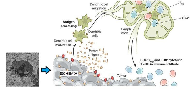 CA4P: Induces Massive Tumor Destruction Following Rapid Ischemic