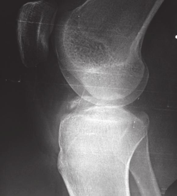 2 Case Reports in Orthopedics Figure 1: Anteroposterior and lateral preoperative radiographs showing tibial eminence and reverse Segond fractures.