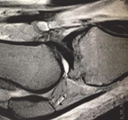 imaging showing intact PCL, avulsion