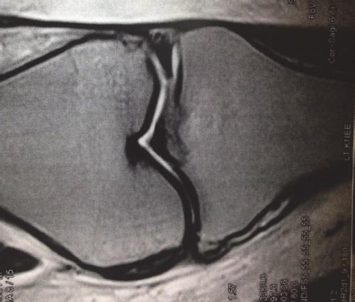 reverse Segond fracture (c), and