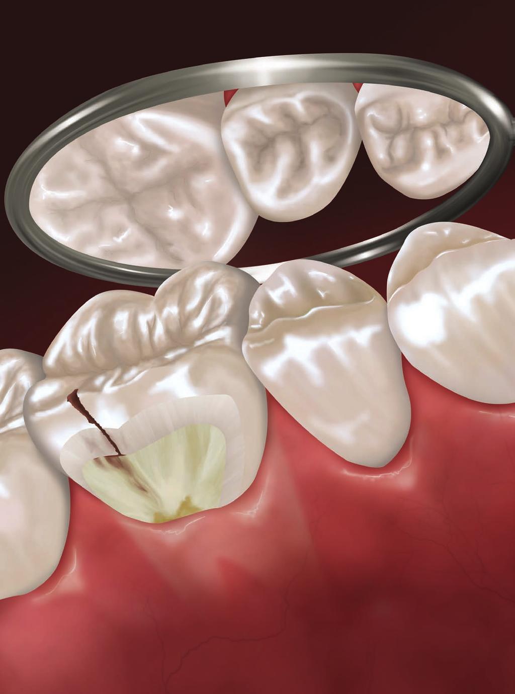 in this section Enamel Caries and Dentin Caries by Trisha E. O Hehir, RDH, MS Hygienetown Editorial Director When I was a child, going to the dentist was a scary and often painful experience.